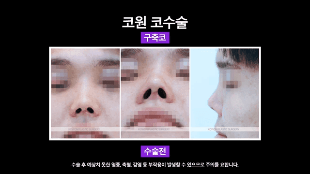 남자 코재수술, 구축으로 들린 코를 자가 조직으로 개선한 사례 관련 이미지 4/8