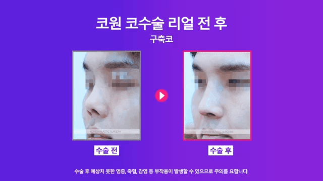 남자 코재수술, 구축으로 들린 코를 자가 조직으로 개선한 사례 관련 이미지 5/8