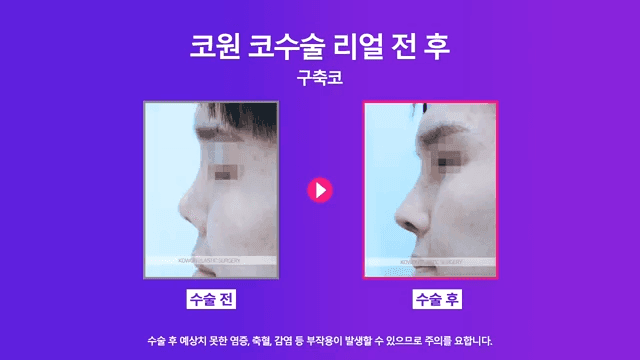 남자 코재수술, 구축으로 들린 코를 자가 조직으로 개선한 사례 관련 이미지 6/8