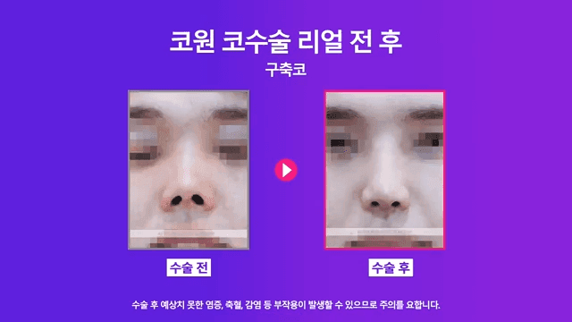 남자 코재수술, 구축으로 들린 코를 자가 조직으로 개선한 사례 관련 이미지 7/8