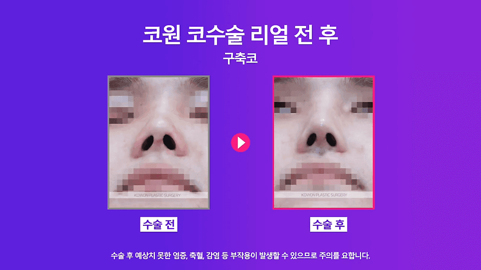 남자 코재수술, 구축으로 들린 코를 자가 조직으로 개선한 사례 관련 이미지 8/8