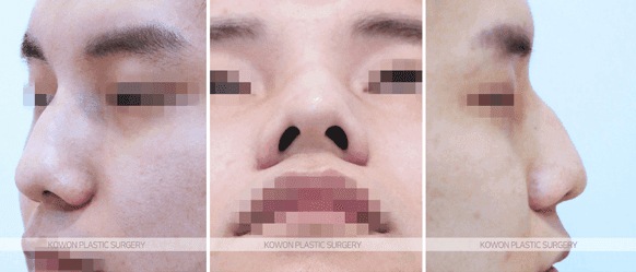 매부리코 사례로 보는 남자 코성형 라인 설계와 회복 흐름 관련 이미지 4/9