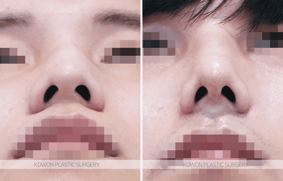 매부리코 사례로 보는 남자 코성형 라인 설계와 회복 흐름 관련 이미지 6/9