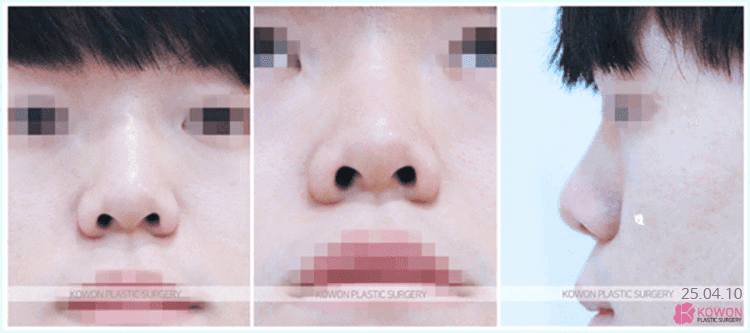 남자 코수술, 티 나지 않는 라인은 무엇을 보고 설계하나 — 라인·재료·지지력 관련 이미지 2/7