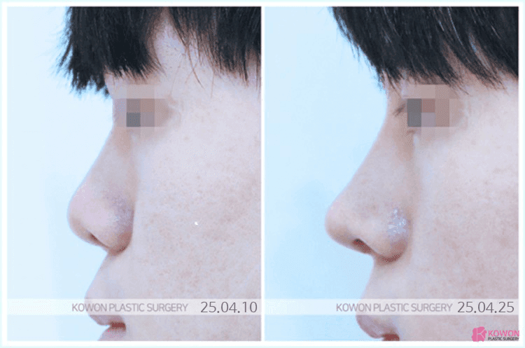 남자 코수술, 티 나지 않는 라인은 무엇을 보고 설계하나 — 라인·재료·지지력 관련 이미지 6/7
