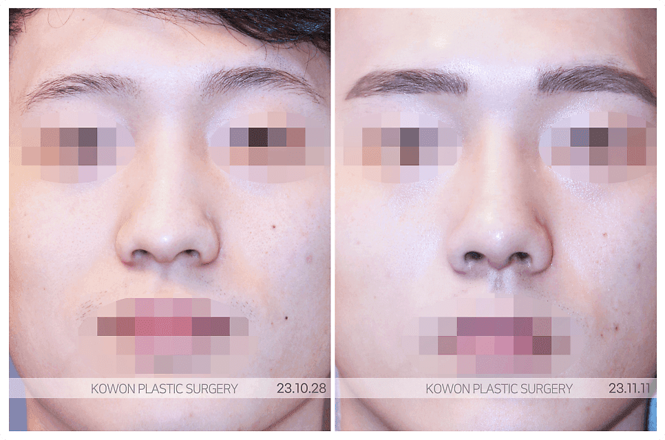 남자 코성형과 RIBFIT™ 리브핏 — 자연스러운 직선 라인을 위해 확인하는 것들 관련 이미지 2/7