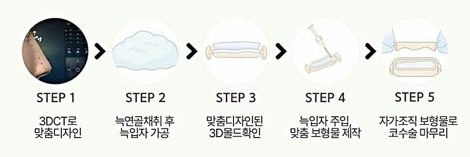 ศัลยกรรมจมูกชายและ RIBFIT™— สิ่งที่ควรตรวจสอบเพื่อให้ได้รูปทรงจมูกที่ตรงเป็นธรรมชาติ ภาพที่เกี่ยวข้อง 5/7