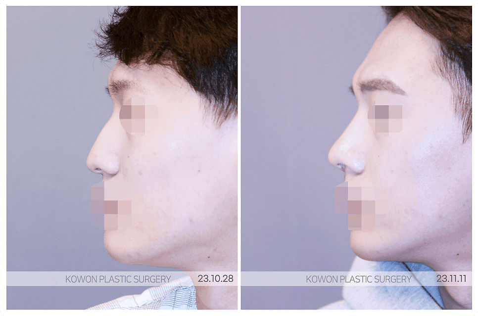 남자 코성형과 RIBFIT™ 리브핏 — 자연스러운 직선 라인을 위해 확인하는 것들 관련 이미지 7/7