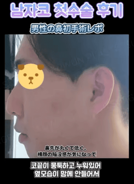 การผ่าตัดจมูกครั้งแรกของผู้ชาย เหตุผลที่ควรพิจารณาไม่ใช้อิมแพลนต์ซิลิโคน และอิมแพลนต์คางพร้อมกัน — ภาพประกอบที่เกี่ยวข้องของกรณีการปรับสมดุลรูปทรงด้านข้าง 2/14