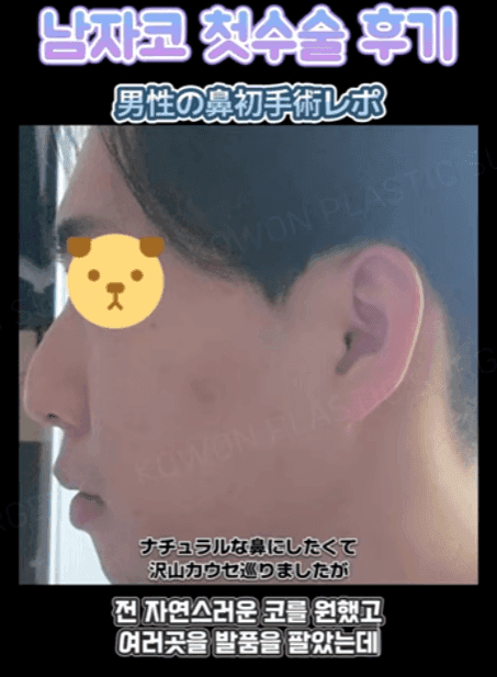 การผ่าตัดจมูกครั้งแรกของผู้ชาย เหตุผลที่ควรพิจารณาไม่ใช้อิมแพลนต์และอิมแพลนต์คางพร้อมกัน — ภาพประกอบที่เกี่ยวข้องของกรณีการปรับสมดุลรูปทรงด้านข้าง 3/14