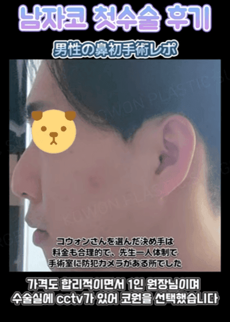 การผ่าตัดจมูกครั้งแรกของผู้ชาย เหตุผลที่ควรพิจารณาไม่ใช้อิมแพลนต์ซิลิโคน และอิมแพลนต์คางพร้อมกัน — ภาพประกอบที่เกี่ยวข้องของกรณีการปรับสมดุลรูปทรงด้านข้าง 4/14