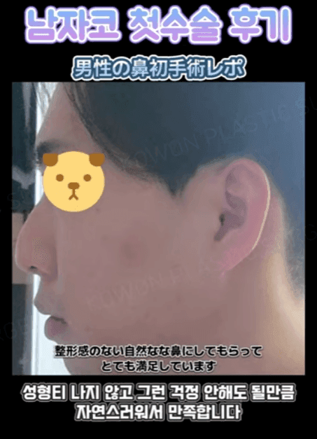 남자 첫 코수술, 무보형물 직선코와 무턱 보형물을 함께 고려한 이유 — 옆모습 균형 사례 관련 이미지 5/14