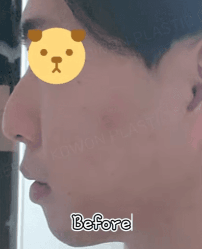 남자 첫 코수술, 무보형물 직선코와 무턱 보형물을 함께 고려한 이유 — 옆모습 균형 사례 관련 이미지 6/14