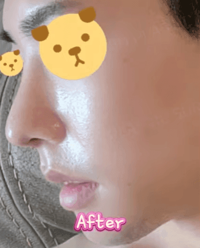 남자 첫 코수술, 무보형물 직선코와 무턱 보형물을 함께 고려한 이유 — 옆모습 균형 사례 관련 이미지 7/14