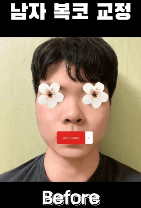 การผ่าตัดจมูกครั้งแรกของผู้ชาย เหตุผลที่ควรพิจารณาไม่ใช้อิมแพลนต์ใช้ซิลิโคน และอิมแพลนต์คางพร้อมกัน — ภาพประกอบที่เกี่ยวข้องของกรณีการปรับสมดุลรูปทรงด้านข้าง 8/14