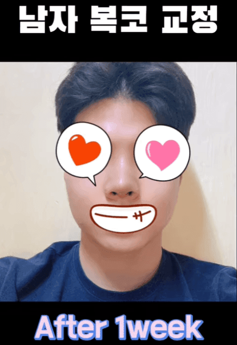 남자 첫 코수술, 무보형물 직선코와 무턱 보형물을 함께 고려한 이유 — 옆모습 균형 사례 관련 이미지 10/14