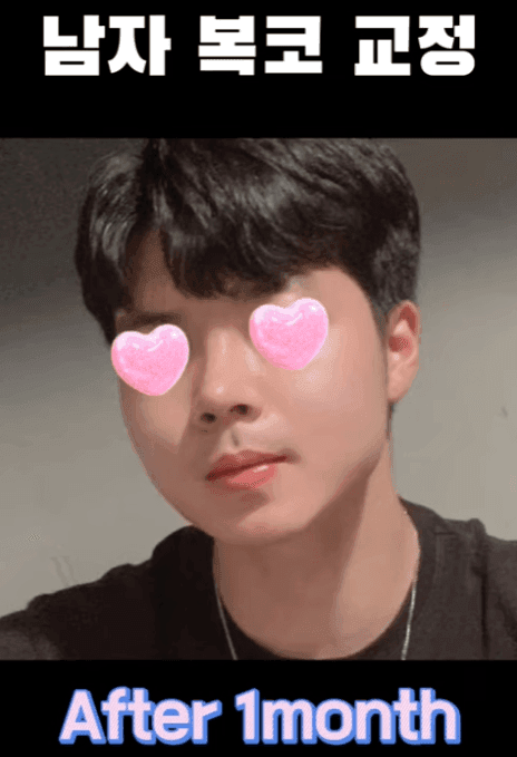 การผ่าตัดจมูกครั้งแรกของผู้ชาย เหตุผลที่พิจารณาไม่ใช้อิมแพลนต์ลิโคนและอิมแพลนต์คางพร้อมกัน — ภาพที่เกี่ยวข้องของกรณีการปรับสมดุลรูปทรงด้านข้าง 11/14