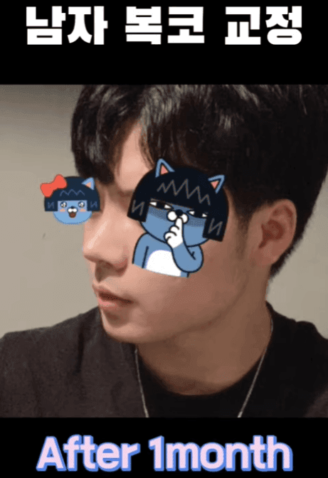 남자 첫 코수술, 무보형물 직선코와 무턱 보형물을 함께 고려한 이유 — 옆모습 균형 사례 관련 이미지 12/14