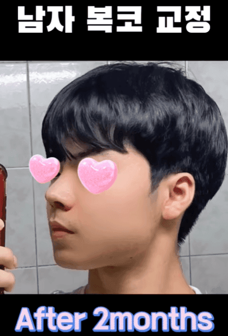การผ่าตัดจมูกครั้งแรกของผู้ชาย เหตุผลที่ควรพิจารณาไม่ใช้อิมแพลนต์ซิลิโคน และอิมแพลนต์คางพร้อมกัน — ภาพประกอบที่เกี่ยวข้องของกรณีการปรับสมดุลรูปทรงด้านข้าง 13/14