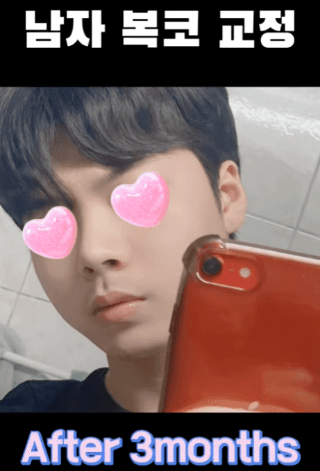 남자 첫 코수술, 무보형물 직선코와 무턱 보형물을 함께 고려한 이유 — 옆모습 균형 사례 관련 이미지 14/14