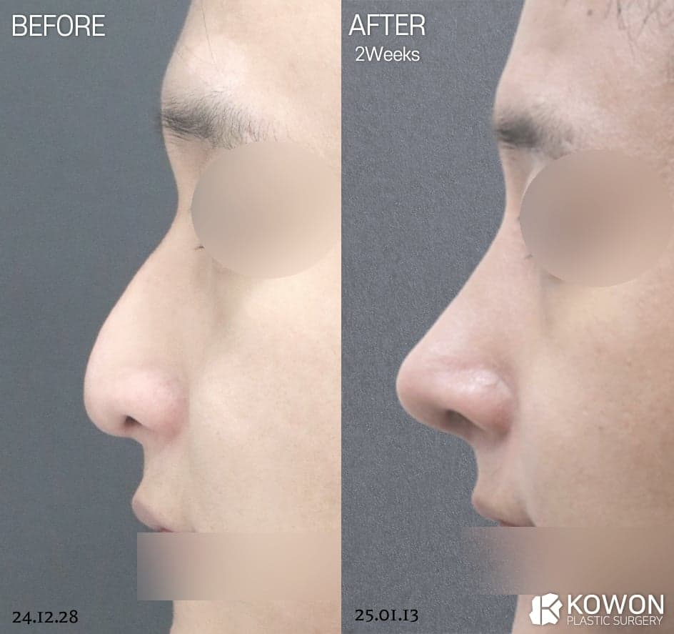 Image 7/7 for: male straight-nose T-zone and material criteria
