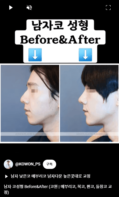 남자 코성형과 T존 입체감 — 미간·콧대·이마를 나눠 보는 세 가지 보완 방법 관련 이미지 10/16