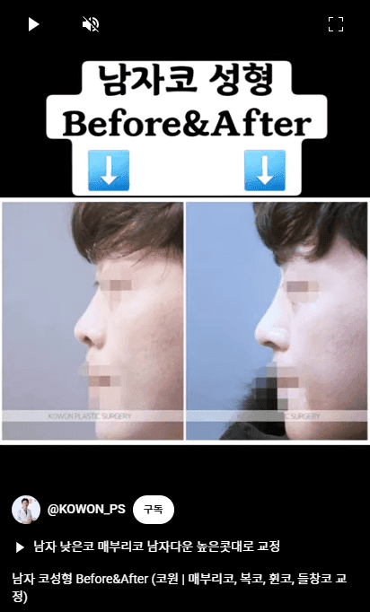 남자 코성형과 T존 입체감 — 미간·콧대·이마를 나눠 보는 세 가지 보완 방법 관련 이미지 12/16