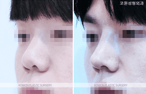 การแก้ไขจมูกเชิด·จมูกสั้นในผู้ชาย: เหตุใดการลดมุมปลายจมูกเพียงอย่างเดียวจึงไม่เพียงพอ — โครงสร้างที่รองรับ ผิวหนัง และสัดส่วน จุดตรวจสอบ ภาพที่เกี่ยวข้อง 3/5