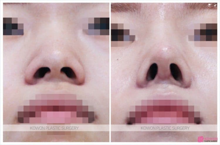코수술 후 코안 점막이 부었다면 — 보형물 제거보다 먼저 확인해야 하는 것 관련 이미지 4/9
