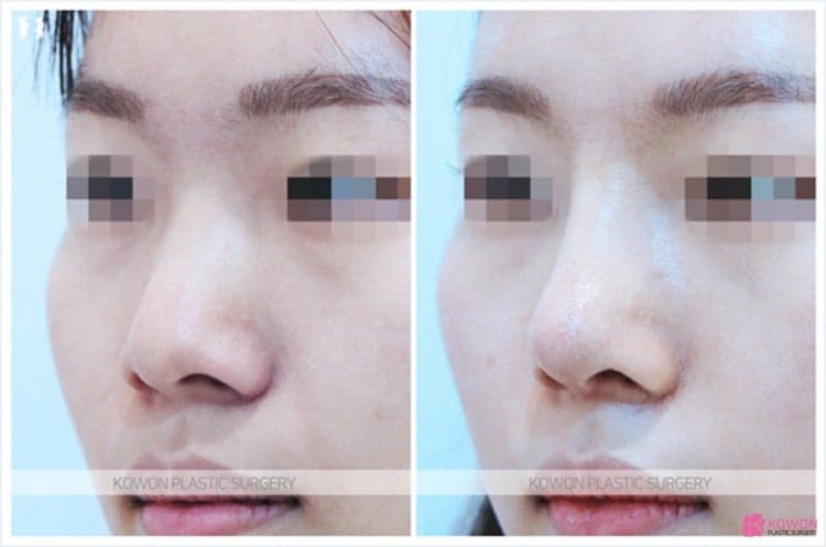 코수술 후 코안 점막이 부었다면 — 보형물 제거보다 먼저 확인해야 하는 것 관련 이미지 5/9