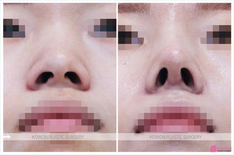 코수술 후 코안 점막이 부었다면 — 보형물 제거보다 먼저 확인해야 하는 것 관련 이미지 7/9
