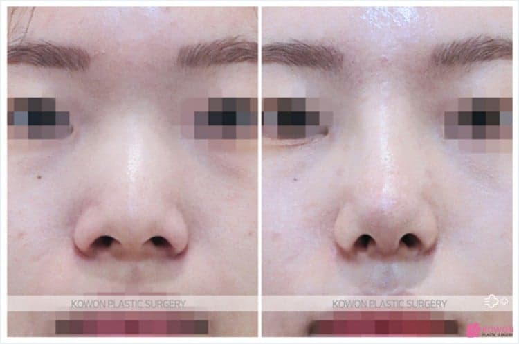 코수술 후 코안 점막이 부었다면 — 보형물 제거보다 먼저 확인해야 하는 것 관련 이미지 8/9