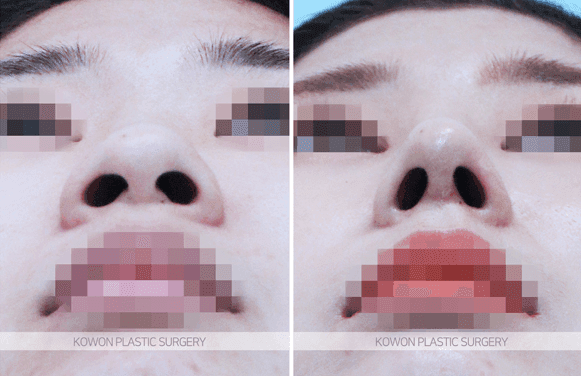 코뼈가 부러진 김에 휜코교정·콧대올리기까지 해도 되나요 — 골절 수술과 미용 성형의 순서 관련 이미지 3/5