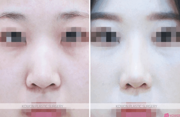 코뼈가 부러진 김에 휜코교정·콧대올리기까지 해도 되나요 — 골절 수술과 미용 성형의 순서 관련 이미지 4/5