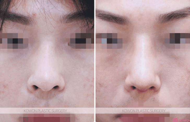 코뼈가 부러진 김에 휜코교정·콧대올리기까지 해도 되나요 — 골절 수술과 미용 성형의 순서 관련 이미지 5/5