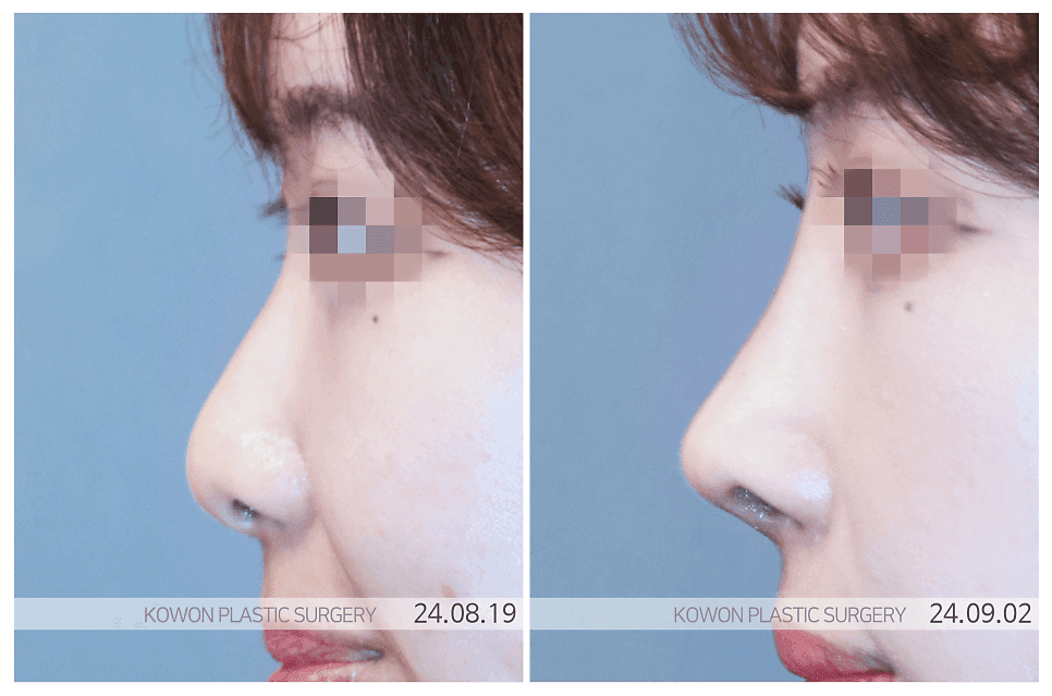 코끝수술 비용, 가격만 보고 결정하기 어려운 이유 — CCTV·집도의·사후관리 확인 순서 관련 이미지 1/4