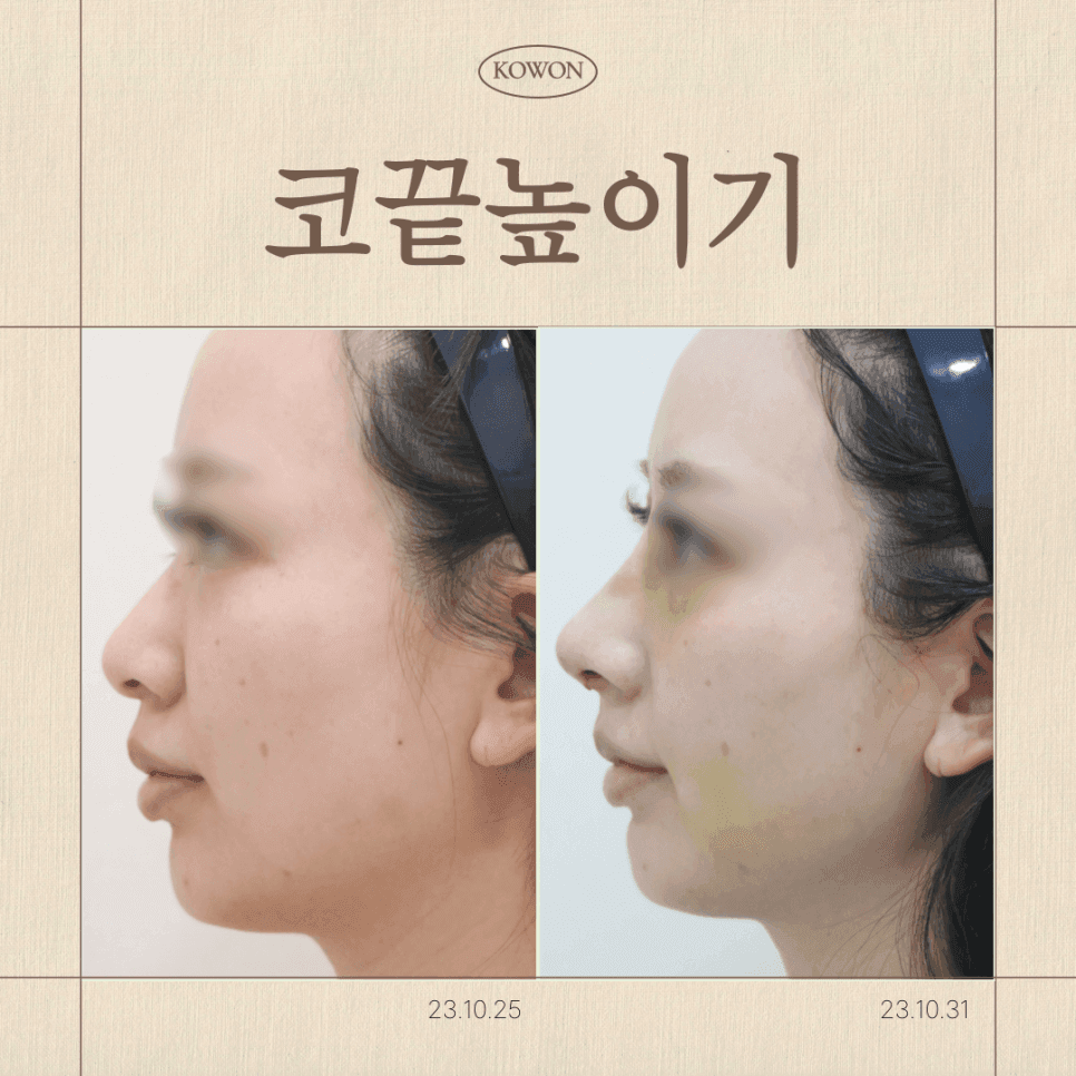 การยกปลายจมูกขึ้นเพียงอย่างเดียว เพียงพอหรือไม่? — ทำไมคุณถึงต้องตรวจสอบมุมระหว่างจมูกกับริมฝีปากก่อน ภาพที่เกี่ยวข้อง 1/7