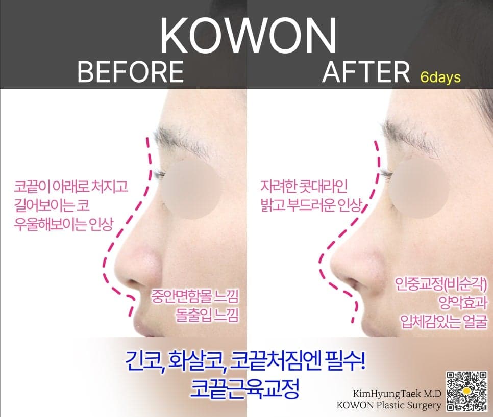 비순각 90도가 왜 중요할까 — C-컬 라인과 돌출입 완화까지 보는 코 디자인 다섯 가지 관련 이미지 2/12