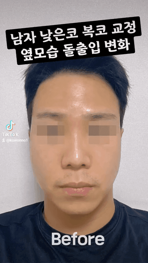 비순각 90도가 왜 중요할까 — C-컬 라인과 돌출입 완화까지 보는 코 디자인 다섯 가지 관련 이미지 3/12