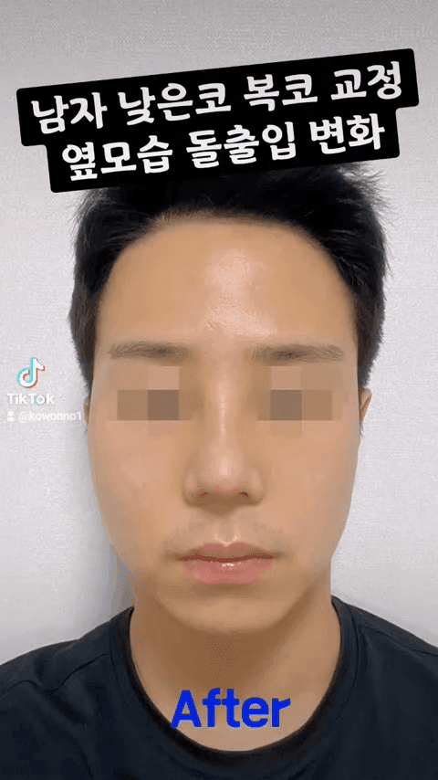 비순각 90도가 왜 중요할까 — C-컬 라인과 돌출입 완화까지 보는 코 디자인 다섯 가지 관련 이미지 4/12
