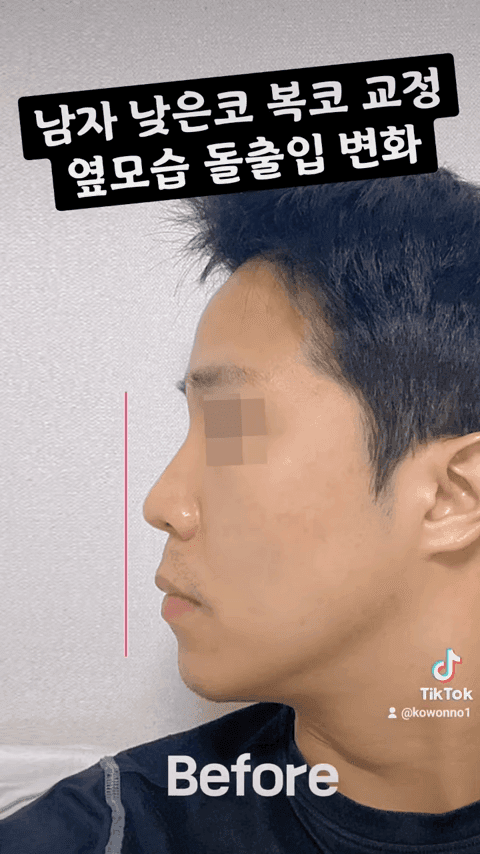 비순각 90도가 왜 중요할까 — C-컬 라인과 돌출입 완화까지 보는 코 디자인 다섯 가지 관련 이미지 5/12