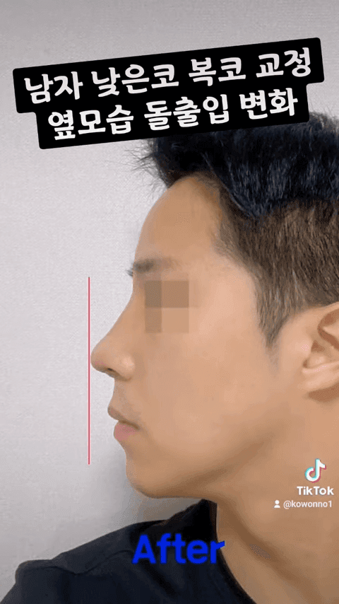 비순각 90도가 왜 중요할까 — C-컬 라인과 돌출입 완화까지 보는 코 디자인 다섯 가지 관련 이미지 6/12