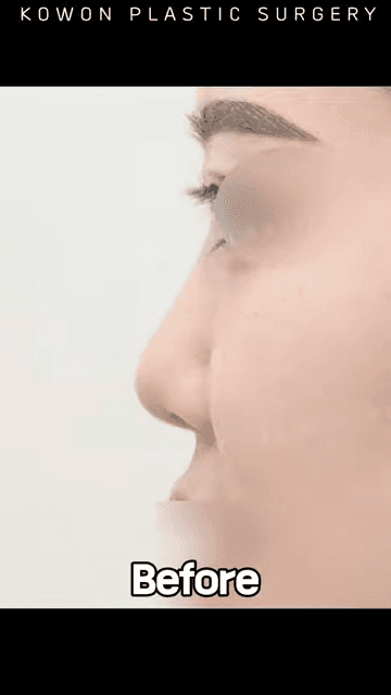 비순각 90도가 왜 중요할까 — C-컬 라인과 돌출입 완화까지 보는 코 디자인 다섯 가지 관련 이미지 7/12