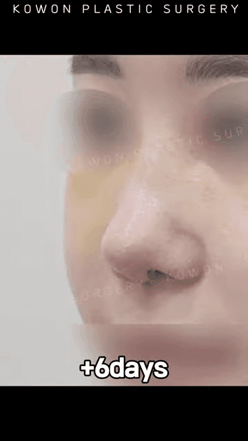 비순각 90도가 왜 중요할까 — C-컬 라인과 돌출입 완화까지 보는 코 디자인 다섯 가지 관련 이미지 10/12