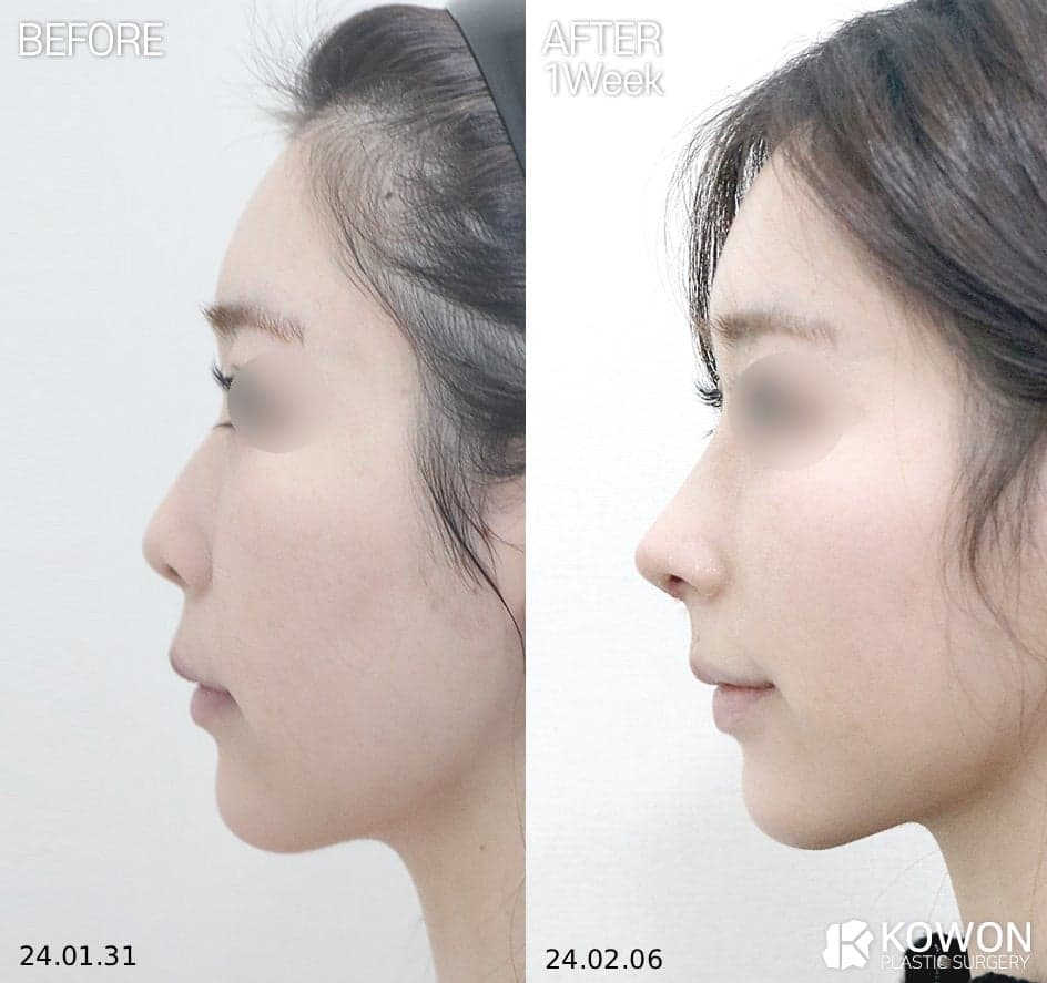 การแก้ไขมุมระหว่างจมูกกับริมฝีปากและการผ่าตัดตกแต่งริมฝีปาก: ความแตกต่างคืออะไร และเมื่อใดที่คุณควรพิจารณา? ภาพที่เกี่ยวข้อง 10/11