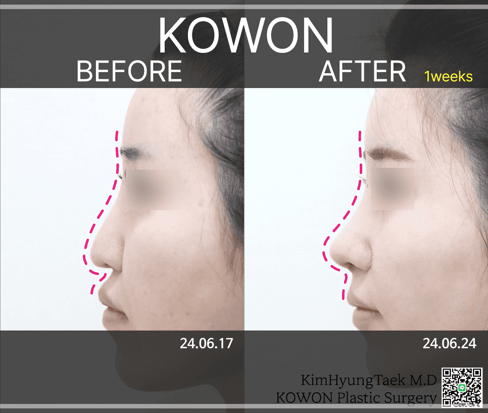 การแก้ไขมุมระหว่างจมูกกับริมฝีปากสามารถทำได้โดยไม่ต้องใช้ซิลิโคนหรือไม่? — ภาพที่เกี่ยวข้องกับภาพลวงตาของปากที่ยื่นออกมาและความหมายของมุม 90 องศา 5/7