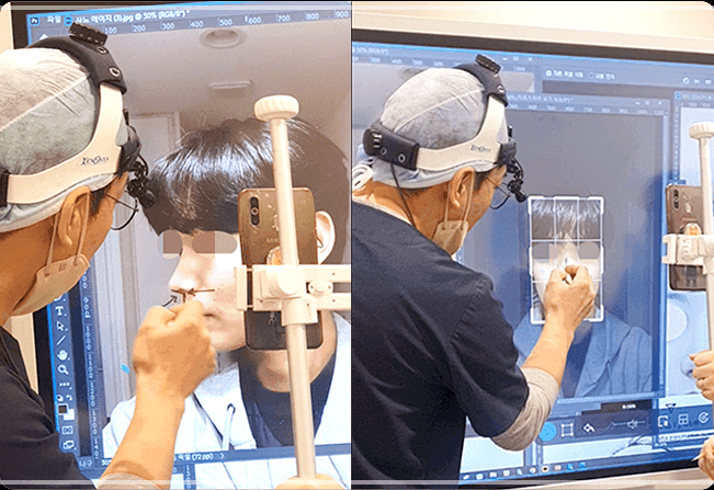 비순각 교정, 실리콘 없이도 가능한가요 — 돌출입처럼 보이는 착시와 90도의 의미 관련 이미지 7/7
