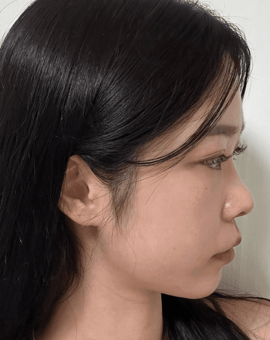 낮은코성형에서 비순각까지 본 사례 — 입이 나와 보이는 인상, 보형물 없이 다룬 이유 관련 이미지 1/13