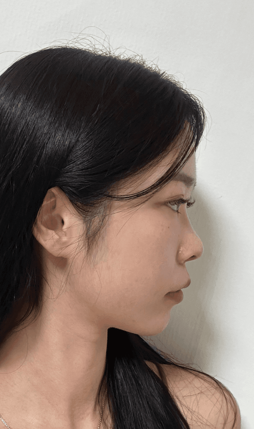 낮은코성형에서 비순각까지 본 사례 — 입이 나와 보이는 인상, 보형물 없이 다룬 이유 관련 이미지 2/13
