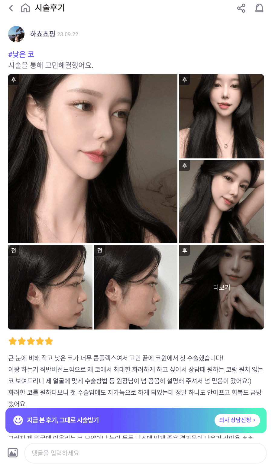 낮은코성형에서 비순각까지 본 사례 — 입이 나와 보이는 인상, 보형물 없이 다룬 이유 관련 이미지 10/13